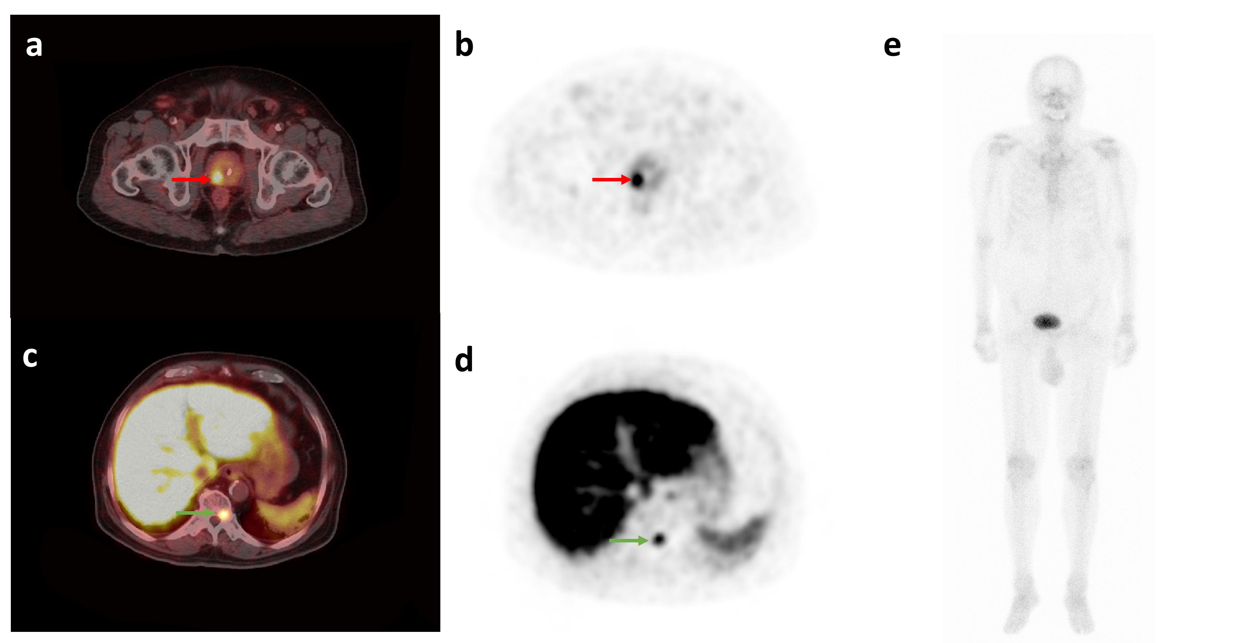 A patient of bone metastasis with PSA 5.78 ng/mL, GS 4 + 4. (a, b) Abnormally increased PSMA uptake in right glands (red arrow), SUVmax is 
28.0. (c, d) The T10 vertebral body with increased PSMA uptake (green 
arrow), SUVmax is 11.5. (e) No concentration of bone on 99mTc-MDP SPECT. (a, c) fused PET/CT; (b, d) axial PET; (e) 99mTc-MDP SPECT.