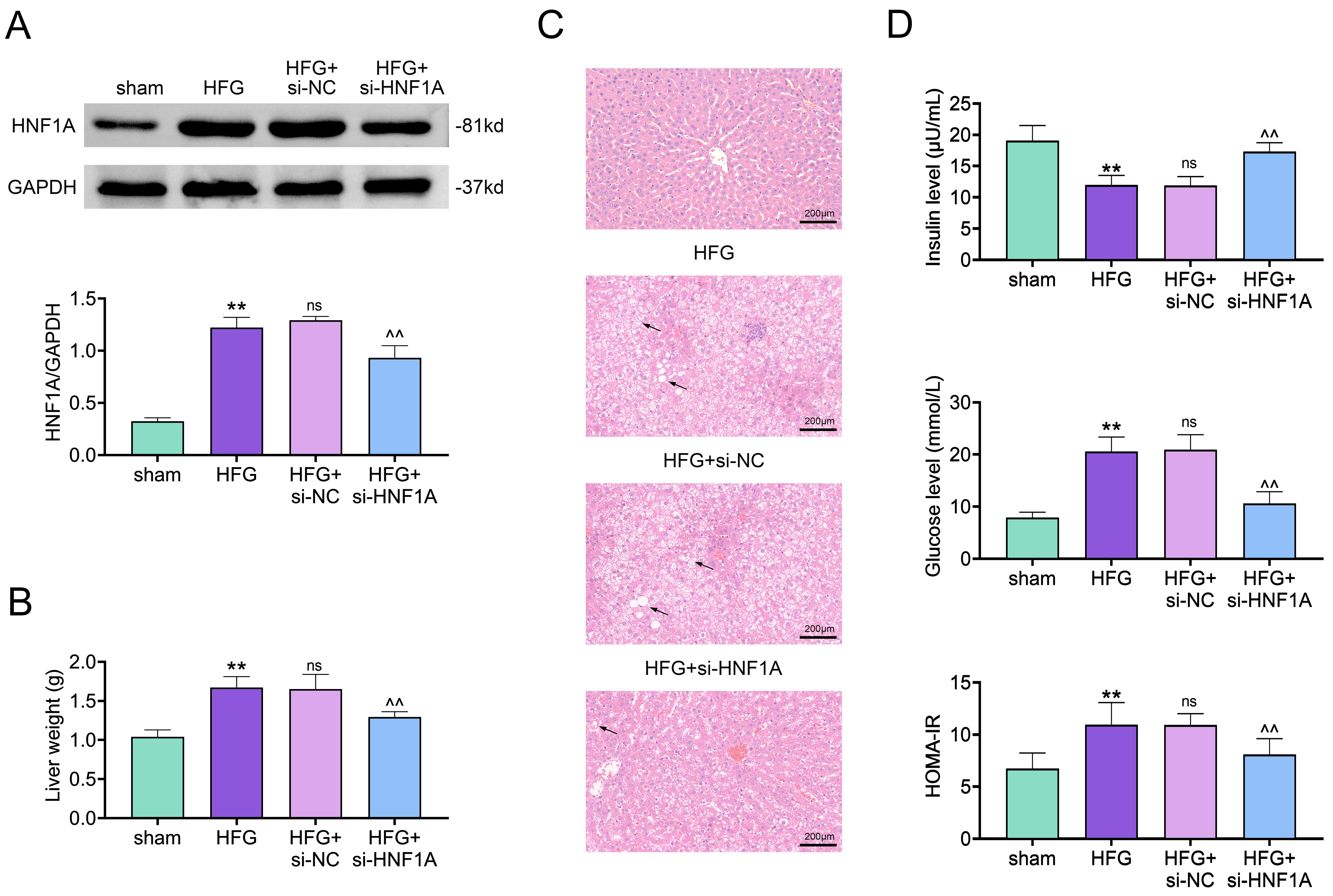 Suppression of HNF1A relieved fatty liver in HFG mice. Groups
were separated into the sham, HFG, HFG + si-NC and HFG + si-HNF1A group. (A) The
knockdown efficiency of HNF1A was ascertained by western blot. (B) The liver
weight was tested. (C) The pathological changes of liver were evaluated by H&E
staining. (D) The insulin, glucose and HOMA-IR was confirmed.
**p < 0.01 vs.
the sham group; ^^p < 0.01
vs. the HFG + si-NC group; no
significance (ns): the HFG group vs. the HFG + si-NC group. HNF1A:
Hepatocyte nuclear factor 1 homeobox A; HFG: high-fat diet plus hyperglycemia;
si-NC: si-negative control; HOMA-IR: homeostasis model assessment of insulin
resistance; GAPDH: glyceraldehyde-3-phosphate dehydrogenase.