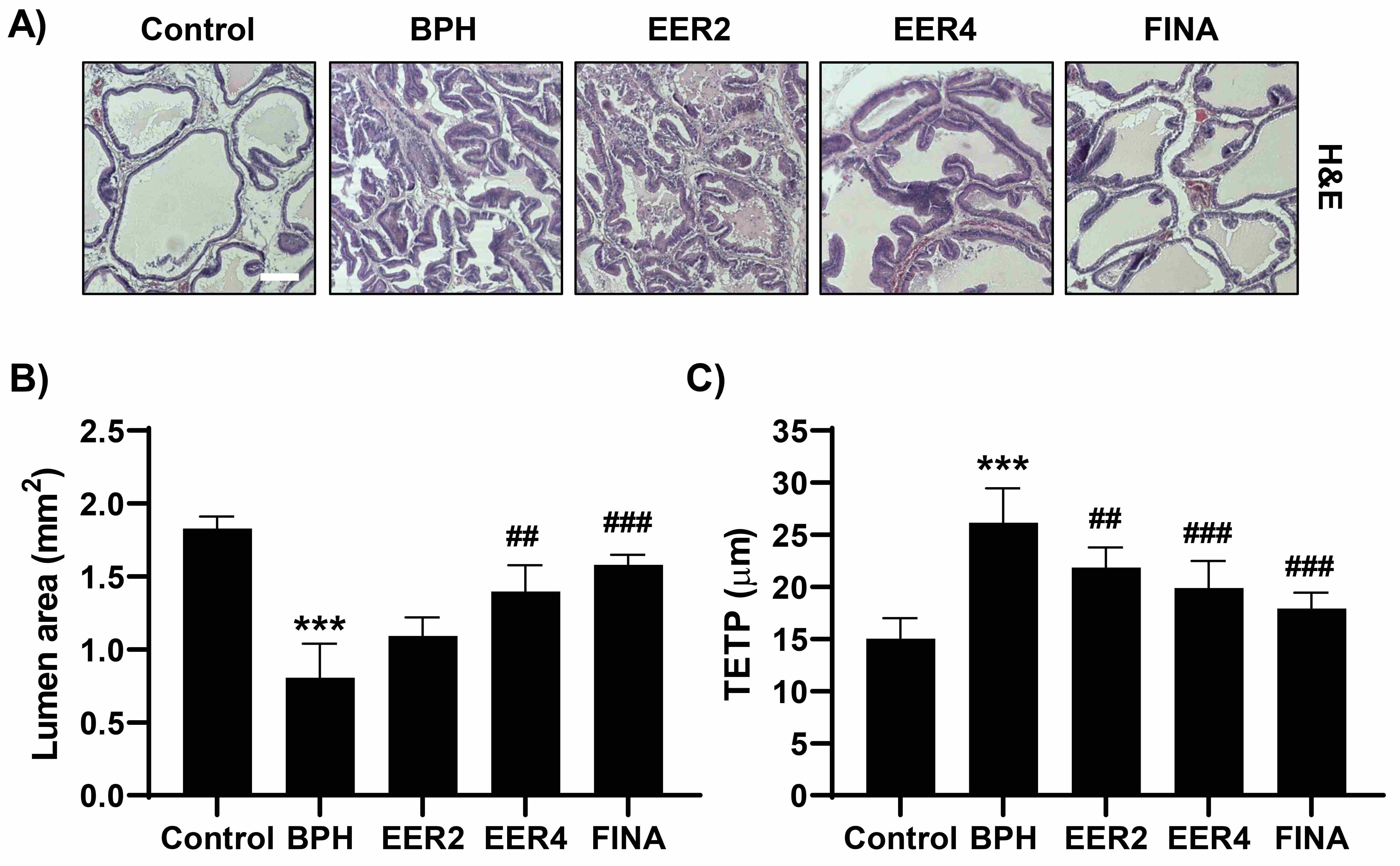 Attenuation of TP-induced histological changes in prostates of
BPH rats induced by EER. (A) Representative images of H&E stained prostate.
(B,C) Measured lumen area (B) and thickness of epithelium tissue from prostate
(TETP, C) of prostate tissue (***p < 0.001 vs.
Control; ##p < 0.01 and ###p < 0.001
vs. BPH). BPH: benign prostatic hyperplasia; EER: Euodia
rutaecarpa fruit; FINA: finasteride; H&E: hematoxylin-eosin.