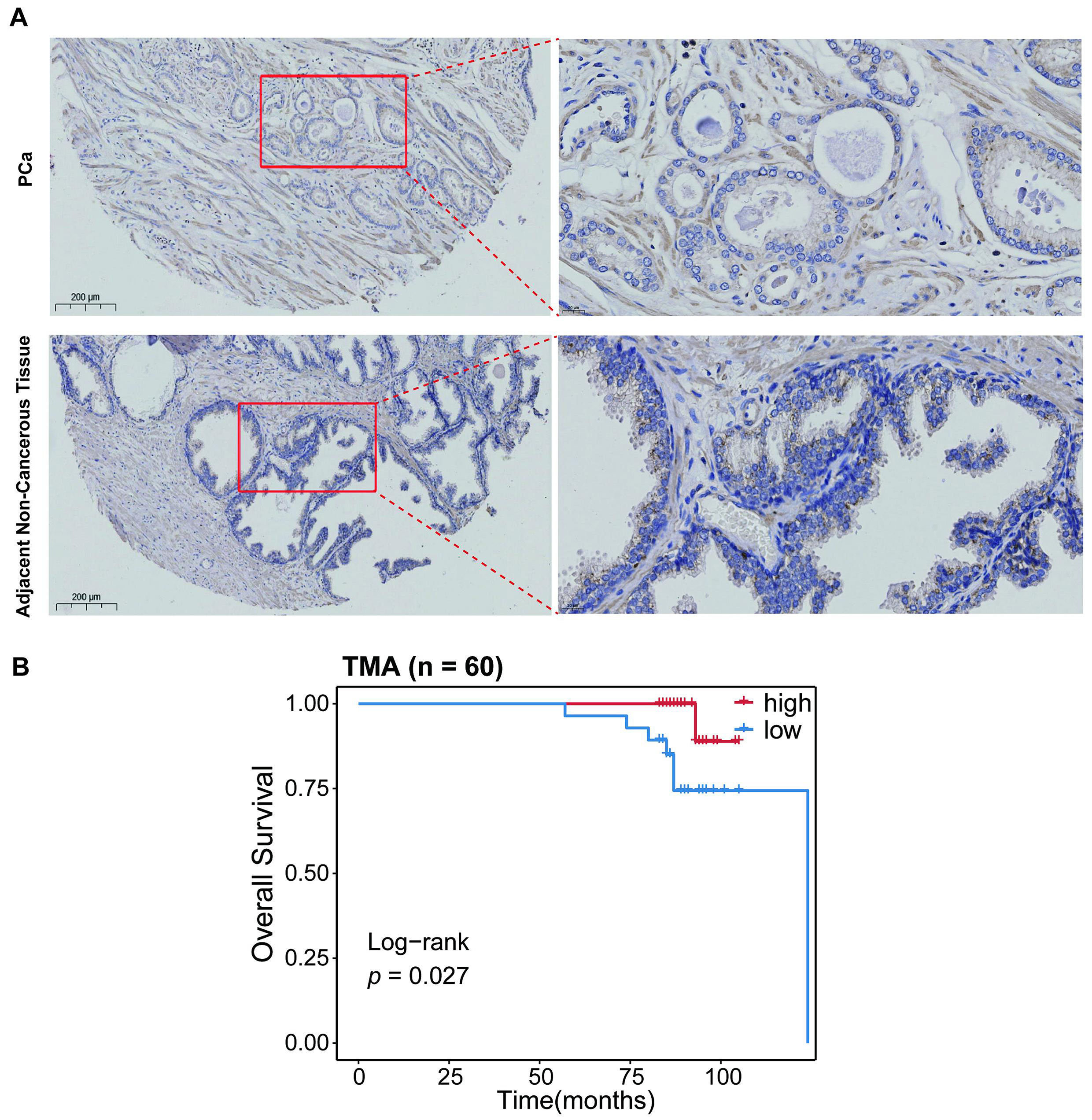 IHC validation of PITPNC1 in local 
cohort. (A) Immunohistochemistry staining of PITPNC1 in PCa and Begin tissue. (B) 
Survival analysis of PITPNC1 IHC score. PCa: Prostate cancer; TMA: Tissue 
microarray; IHC: immunohistochemistry.