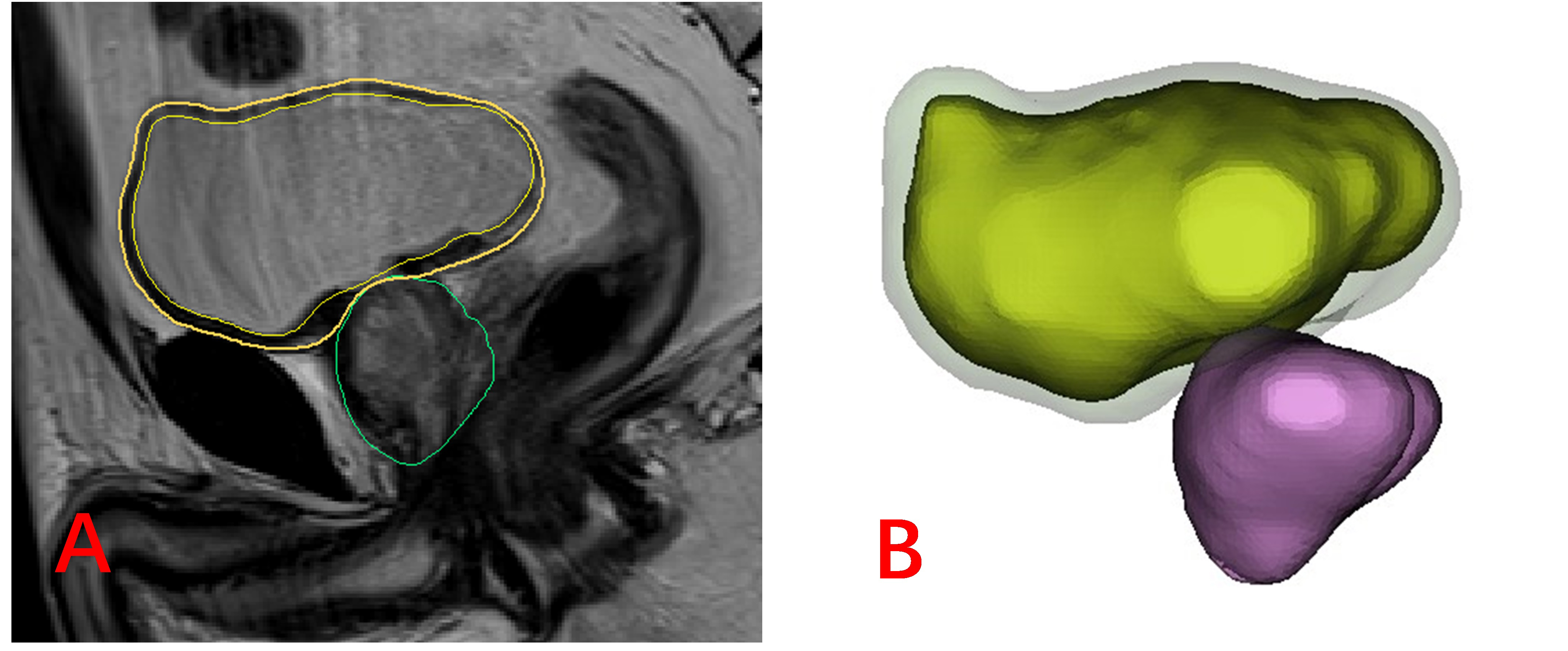 3D reconstruction process with Mimics software using Pelvic 
sagittal MRI. (A) Segmentation of the bladder serosa, bladder lumen and prostate 
were performed. (B) Calculated 3D model of the bladder serosa, bladder lumen and 
prostate. Transparent represents the bladder wall, yellow represents urine and 
purple represents the prostate.