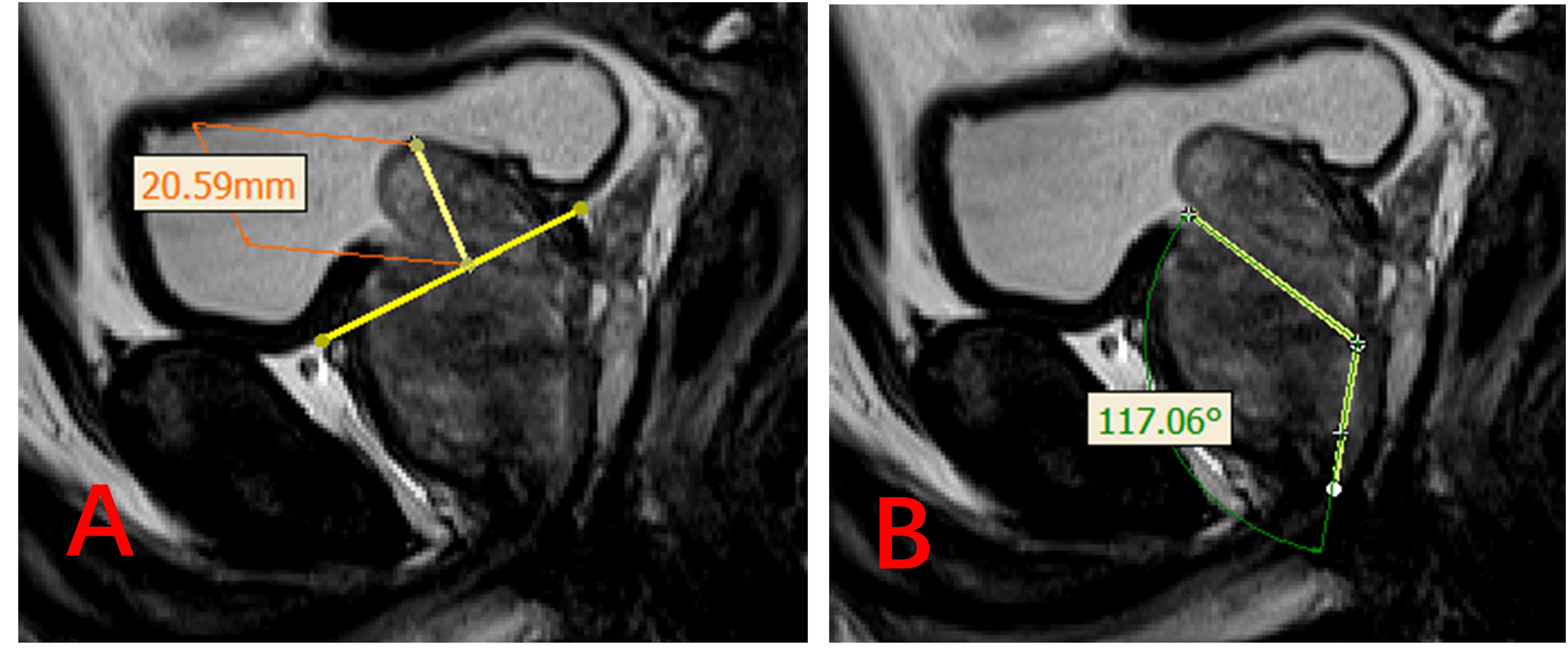Measurement methods for IPP and PUA on Sagittal T2-weighted images. (A) 
Demonstrates how to measure IPP. (B) Demonstrates how to measure PUA.