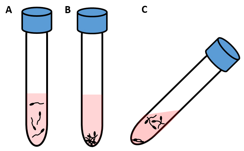 Swim-up method. (A) semen sample before centrifugation; (B)
sample after centrifugation, all cells are in the pellet; (C) sample after 45–60
minutes of incubation at a 45° angle, motile spermatozoa are at the
surface, while non-motile spermatozoa remain in the pellet.