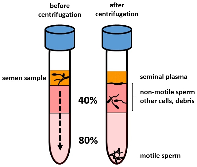 Sperm separation by density gradient centrifugation.