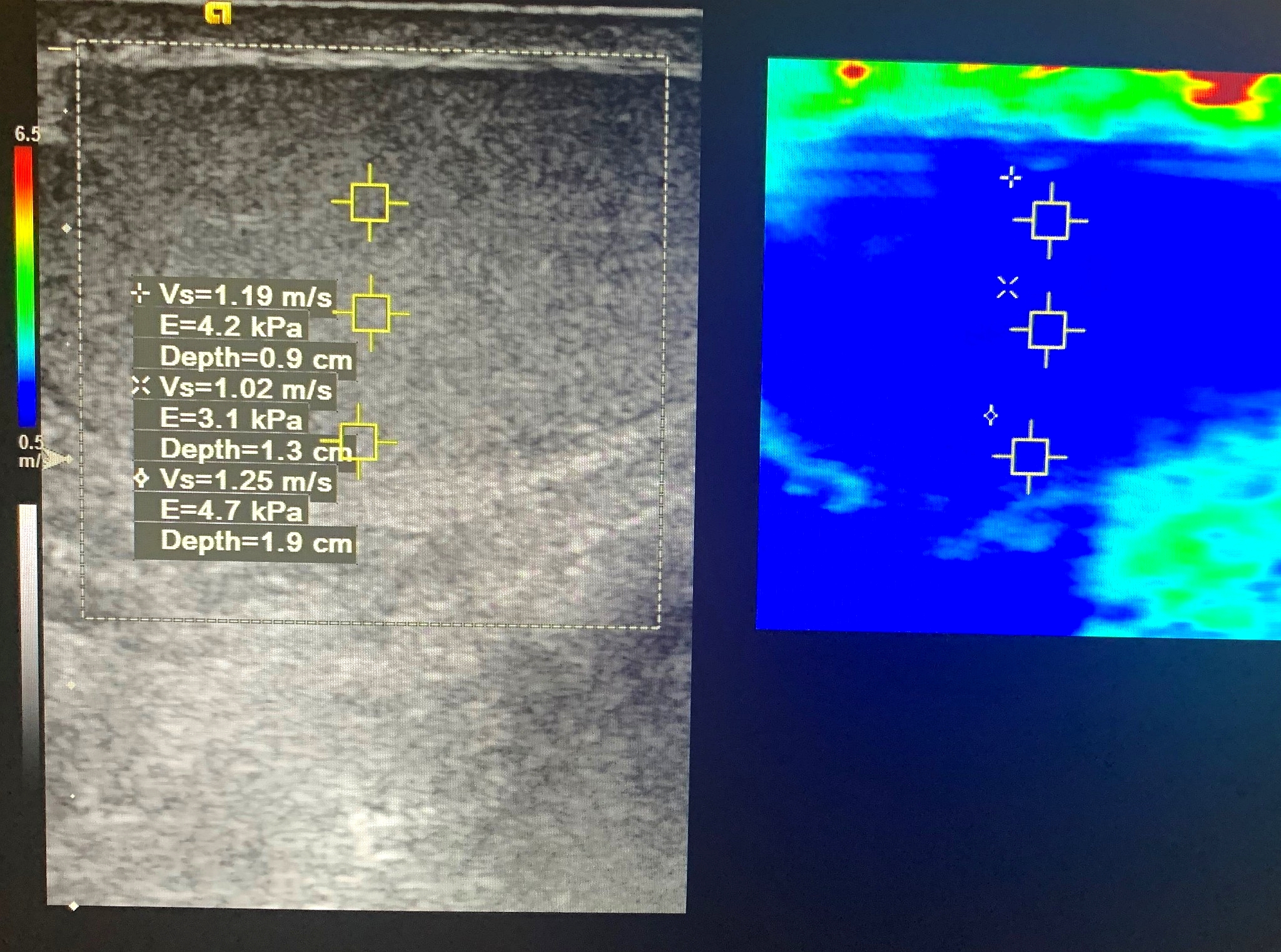 Elastography image of a TESE-positive patient with 
azoospermia. The image of three points of shear wave elastography measurements 
from each testis, including the upper, middle and lower poles.
