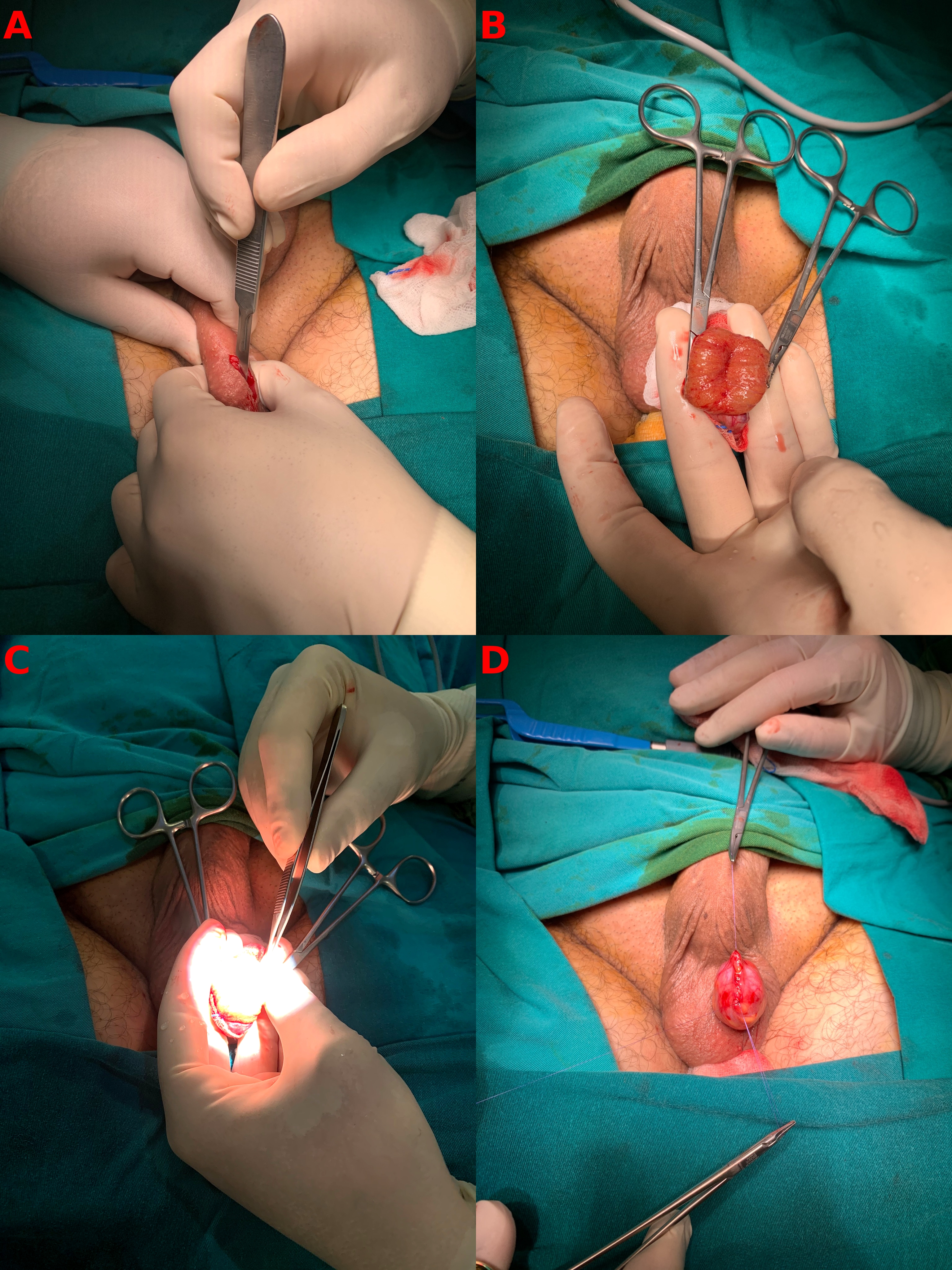 Images of a micro-TESE surgery. (A) The testicle is accessed via 
a vertical incision from the scrotal raphe. (B) The tunica albuginea is then 
incised, and the testicle is divided in two. (C) The seminiferous tubules are 
accessed and dissected with the guidance of a microscope. (D) Following the 
procedure, the layers are anatomically closed.
