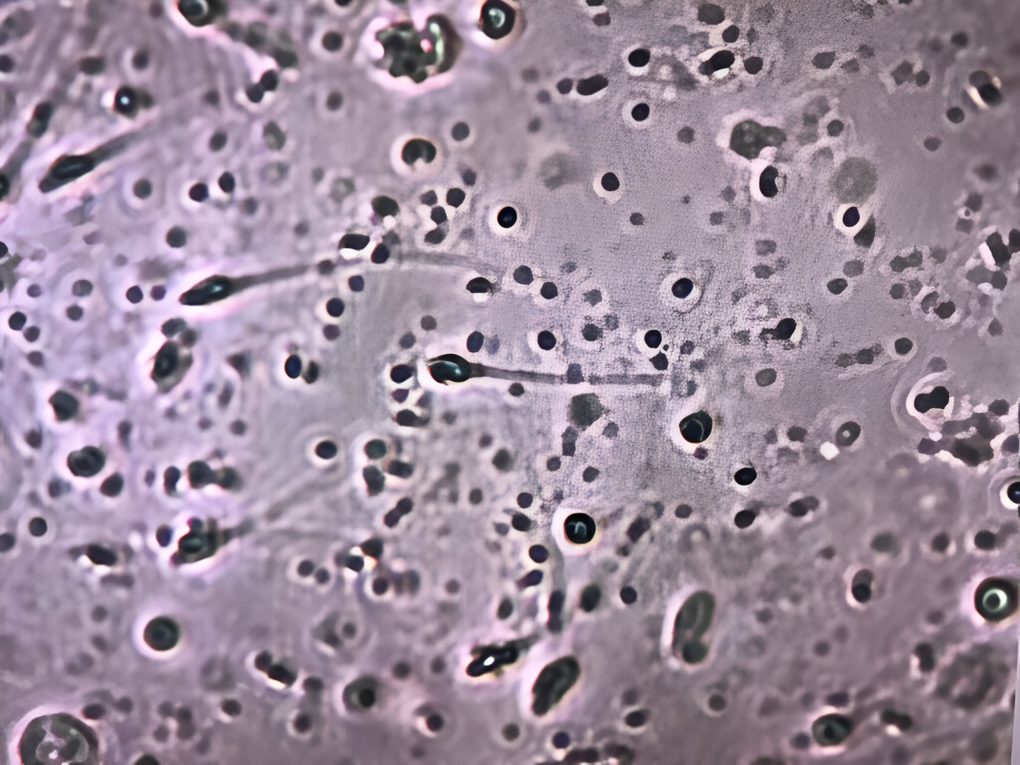 Microscopic view (20–25× magnification) of sperm in a 
TESE-positive patient.