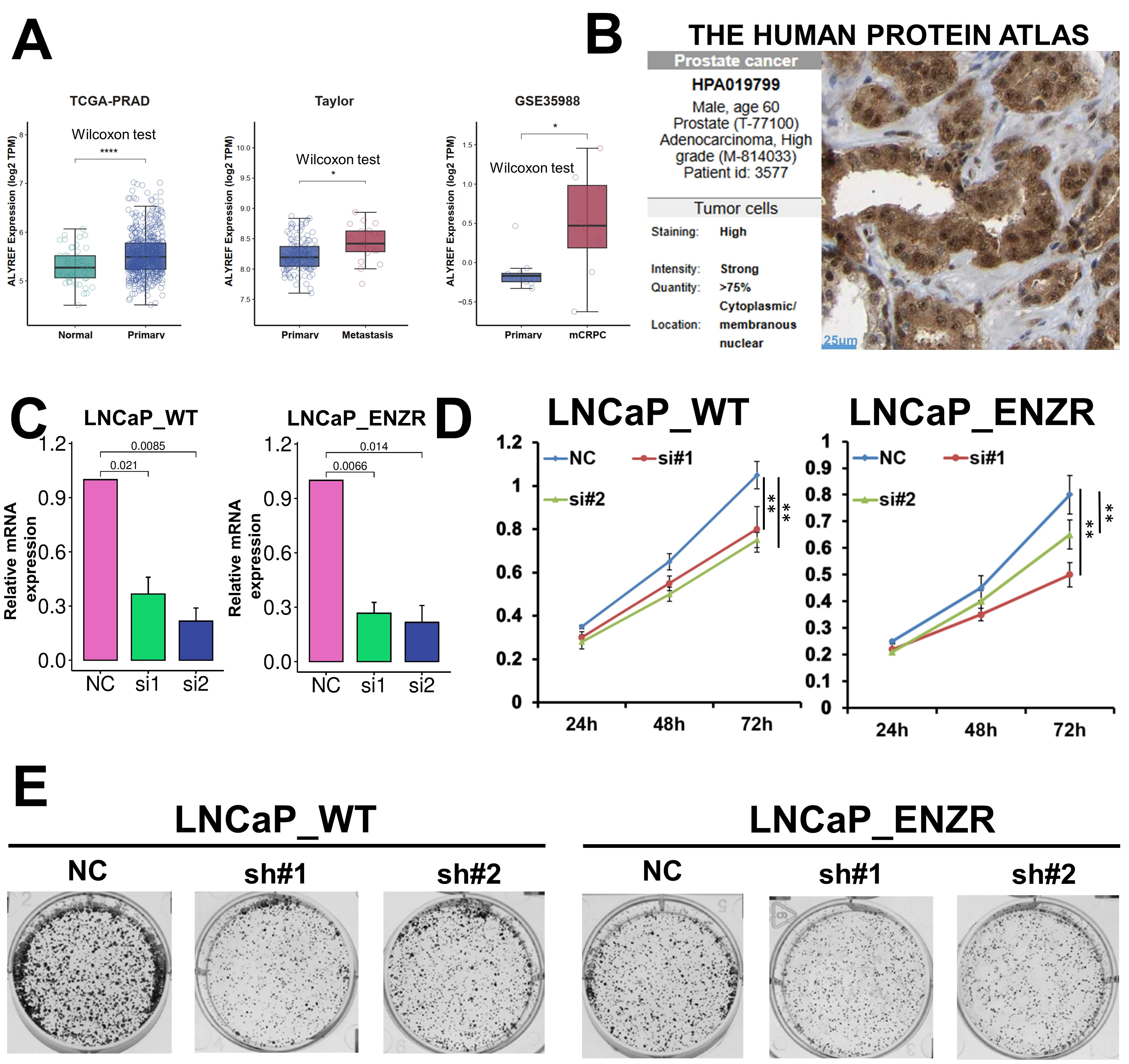Validation of ALYREF expression and functional role in
prostate cancer. (A) Boxplots comparing ALYREF mRNA expression across
benign, primary, and advanced prostate cancer stages. (B) Immunohistochemistry
(IHC) images from the Human Protein Atlas (HPA) showing ALYREF protein
expression in prostate tissue. (C) Bar graph depicting relative ALYREF
mRNA expression in LNCaP wild-type (LNCaP_WT) and enzalutamide-resistant
(LNCaP_ENZR) cell lines following transfection with negative control (NC) siRNA
or two ALYREF-targeting siRNAs (si#1, si#2), with statistical
significance indicated. (D) Growth curves from CCK-8 assays showing cell
viability over 72 hours in LNCaP_WT and LNCaP_ENZR cells transfected with NC
siRNA or ALYREF-targeting siRNAs, demonstrating reduced proliferation
upon knockdown. (E) Representative images of colony formation assays in LNCaP_WT
and LNCaP_ENZR cells transfected with NC shRNA or two ALYREF-targeting
shRNAs (sh#1, sh#2). NC: negative control. (*p < 0.05,
**p < 0.01, ****p < 0.0001).