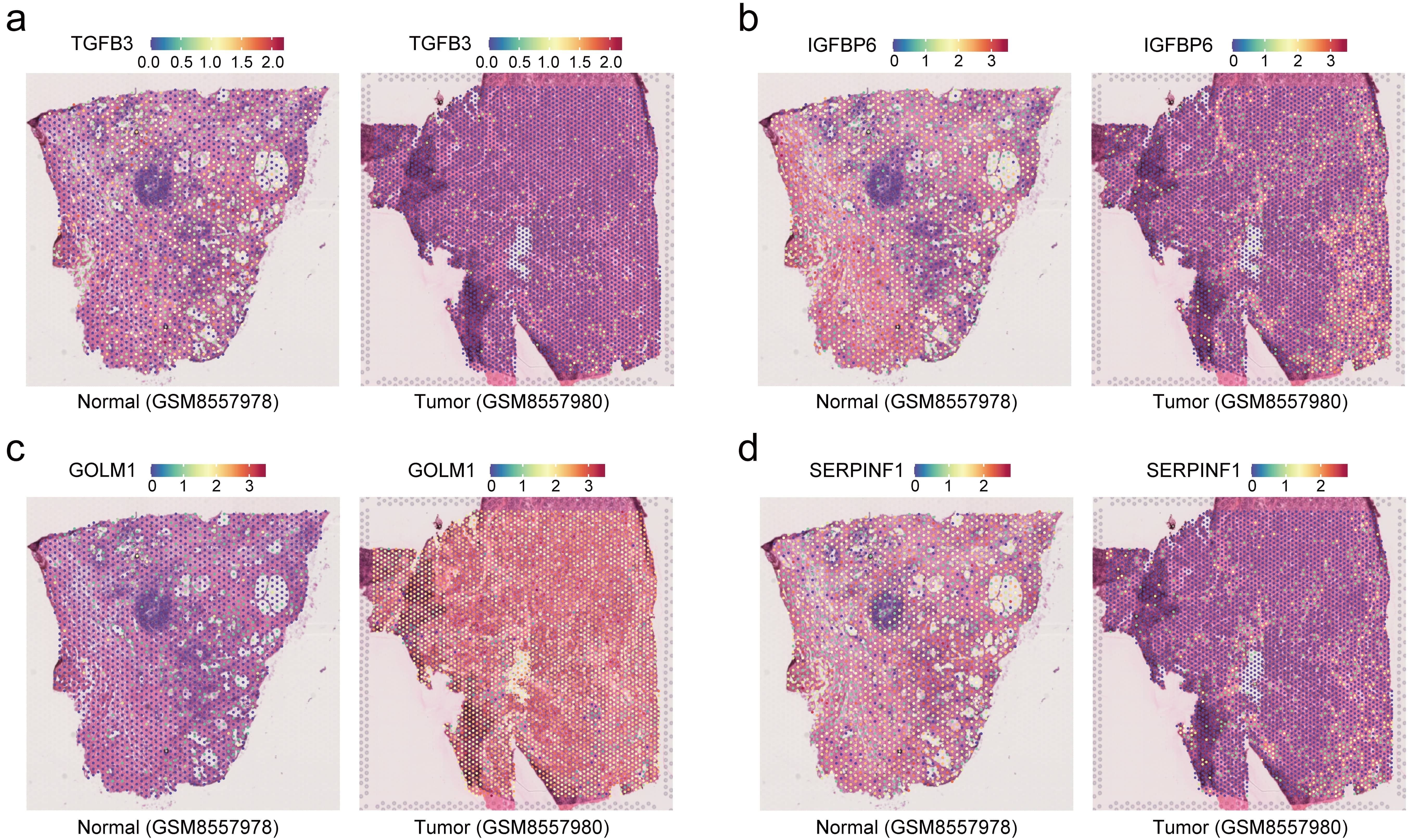 Spatial expression patterns of key biomarkers in PCa. The 
spatial transcriptomics data were analyzed to evaluate the expression patterns of 
(a) TGFB3, (b) IGFBP6, (c) GOLM1, (d) and SERPINF1 in normal prostate and PCa 
tissues. TGFB3, Transforming Growth Factor Beta 3; IGFBP6, Insulin-Like Growth 
Factor Binding Protein 6; GOLM1, Golgi Membrane Protein 1; SERPINF1, Serpin 
Family F Member 1.