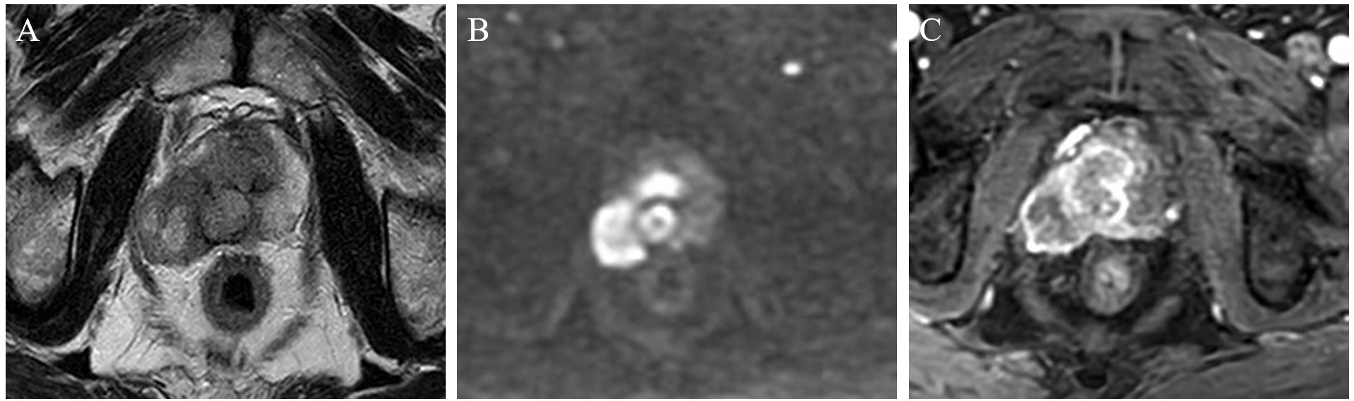 Imaging manifestations of NEPC on mp-MRI. (A) The lesion in the
central gland and right peripheral zone of the prostate extends beyond the
prostate capsule. (B) markedly restricted diffusion. (C) early heterogeneous
enhancement following contrast administration.