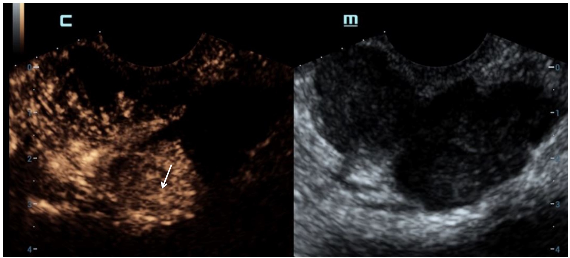 CEUS demonstrates the tumor-feeding vessel (white arrow).
