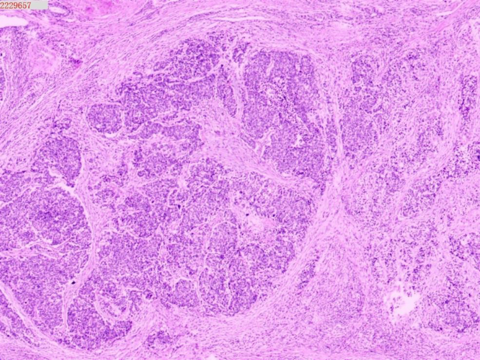 Pathological image of mixed neuroendocrine carcinoma (HE
×100).