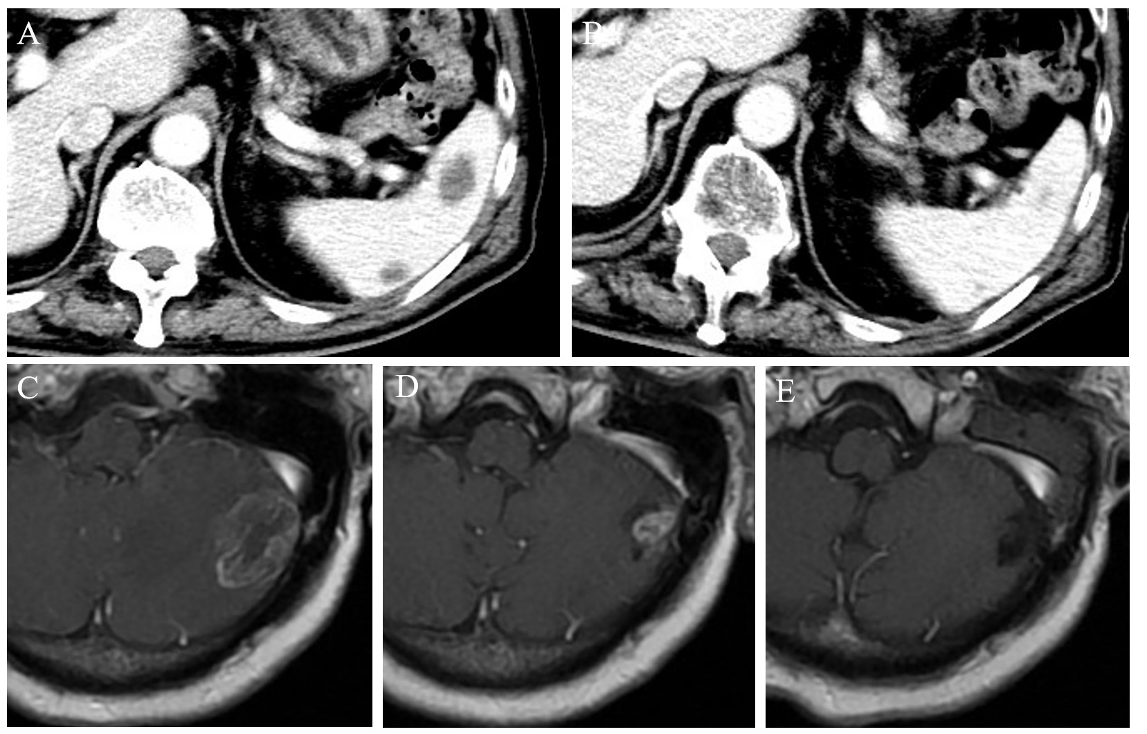 Follow-up imaging after chemotherapy for metastatic lesions.
(A,B) Splenic lesions at 11 and 28 months postoperatively. (C–E) Intracranial
lesions at 11, 18, and 28 months postoperatively.